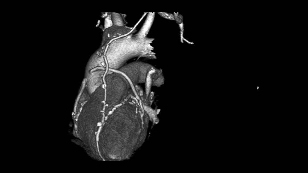 КТ ангиография коронарных артерий в Екатеринбурге - цена, сделать КТ ...